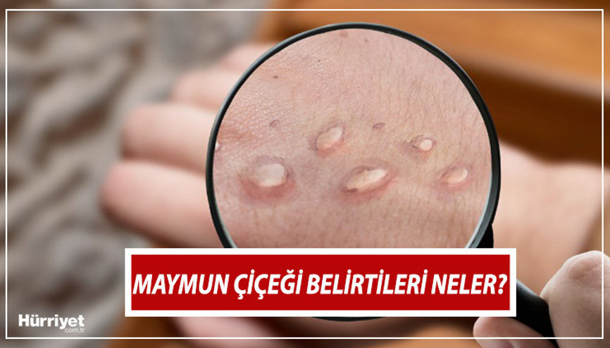 Maymun çiçeği nedir, nasıl anlaşılır Maymun çiçeği virüsü belirtileri nelerdir İşte tedavisi ve semptomları hakkında bilgiler Maymun çiçeği nedir, nasıl anlaşılır Maymun çiçeği virüsü belirtileri nelerdir İşte tedavisi ve semptomları hakkında bilgiler