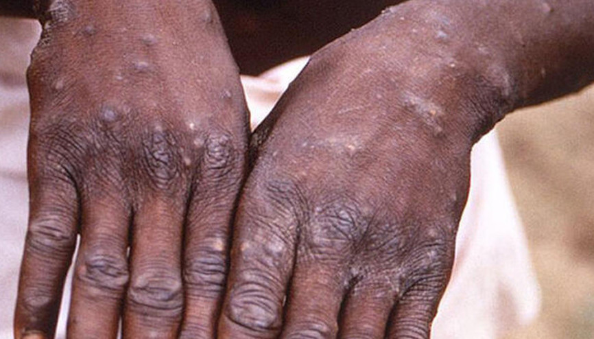 ABDde maymun çiçeği virüsü alarmı: Acil durum ilan edildi