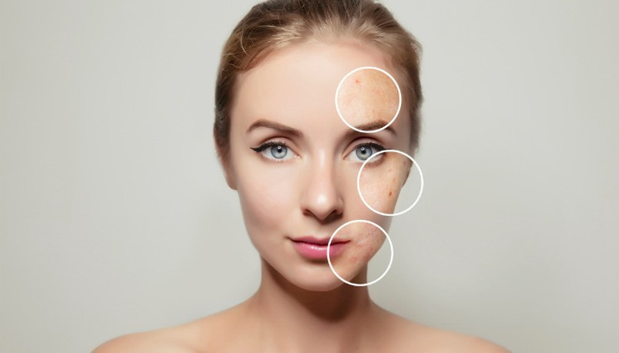 Sivilceler (akneler) nasıl tedavi edilir