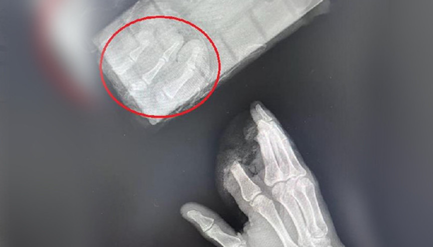 Bursada korkunç olay: Kopan parmaklarını poşetle hastaneye götürdü