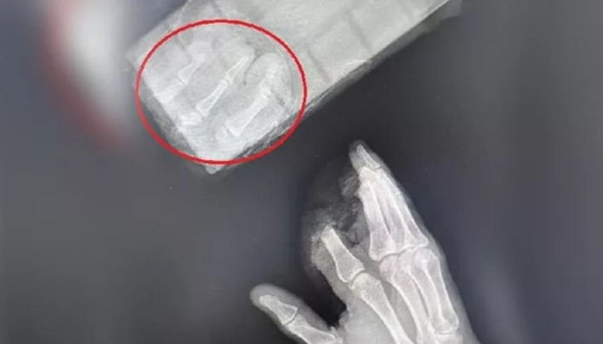 Kopan parmaklarını poşetle hastaneye götürdü, 12 saatte dikildi
