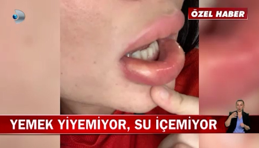 Dudak estetiği hayatını karartı