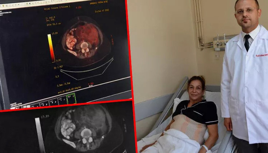 Şişkinlik şikayetiyle gitti, karnından 10 kiloluk kitle çıkartıldı