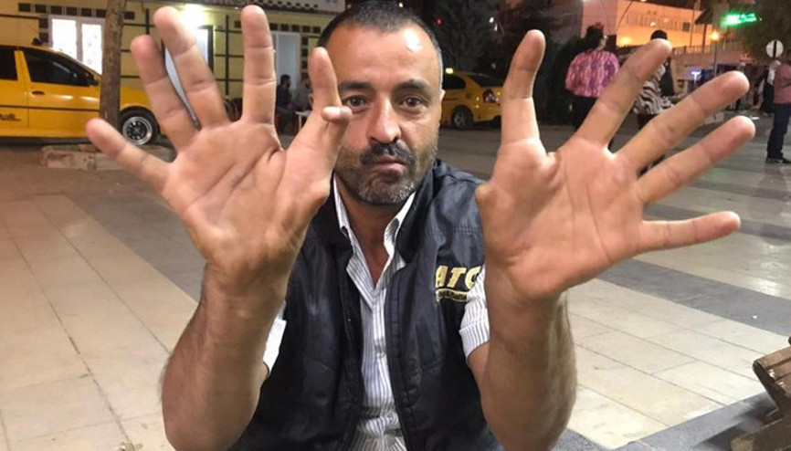 Elazığda 11 parmaklı adam görenleri hayrete düşürüyor