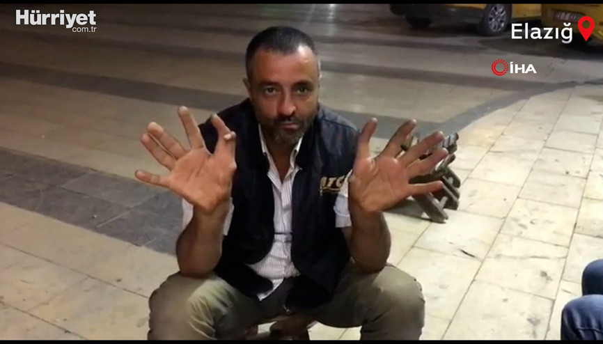 Elazığ’da 11 parmaklı adam görenleri hayrete düşürüyor