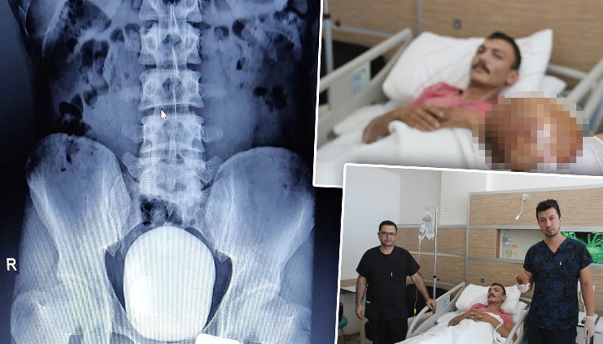 Yanma şikayetiyle gitti, mesanesinden 1 kilo taş çıktı