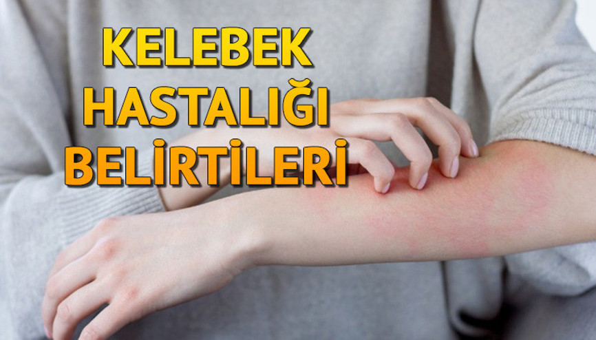 Kelebek hastalığı (Lupus) nedir, belirtileri nelerdir Kelebek hastalığı nedenleri ve tedavisi hakkında bilgiler