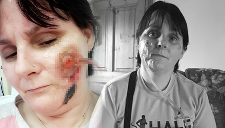 Temizlik yaparken hayatının kâbusunu yaşadı Yüzünde kocaman bir delik oluştu, 10 ameliyat geçirdi