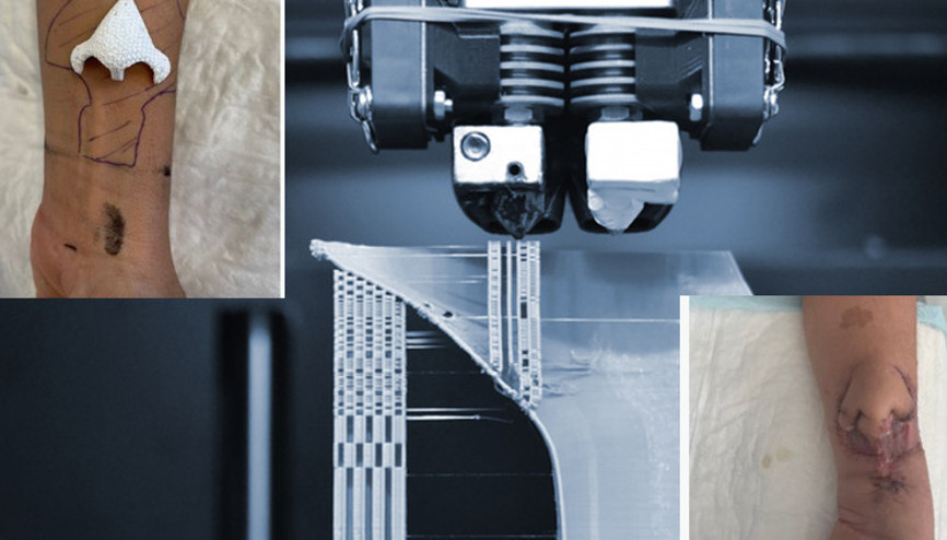 Kanser yüzünden kaybettiği burnunu, kolunda yeniden büyüttü