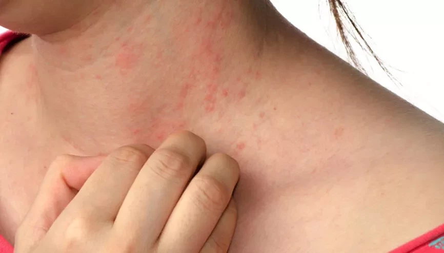 Scabies nedir Scabies hastalığı hakkında önemli uyarılar