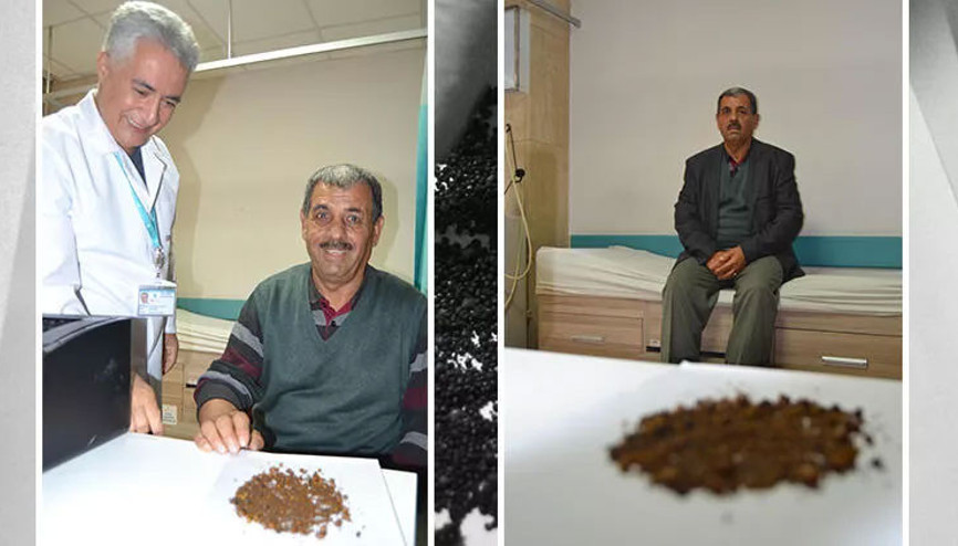 Safra kesesinden 4 bin 536 taş çıktı