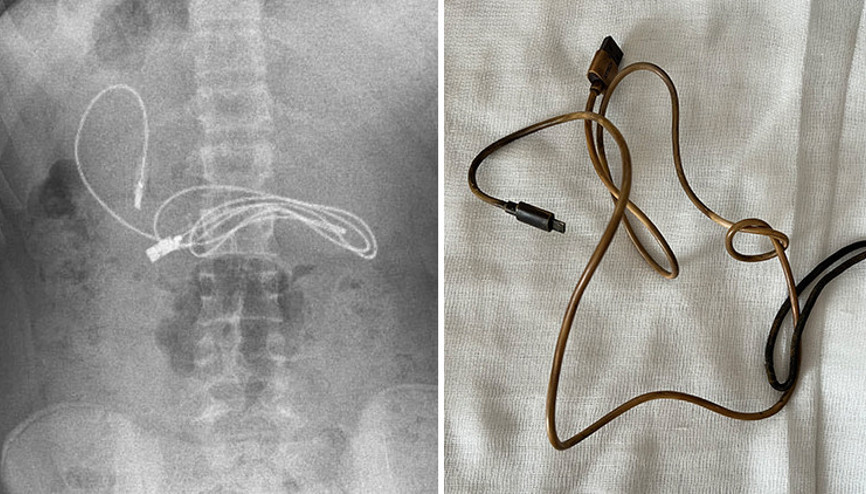 Elazığda doktorları şaşırtan olay Midesinden telefon kablosu çıktı