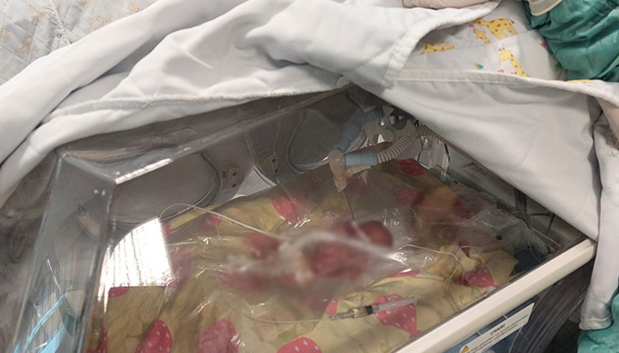 Türkiye’nin en küçük bebeklerinden biri daha doğdu Tekirdağ’da 310 gramlık bebek