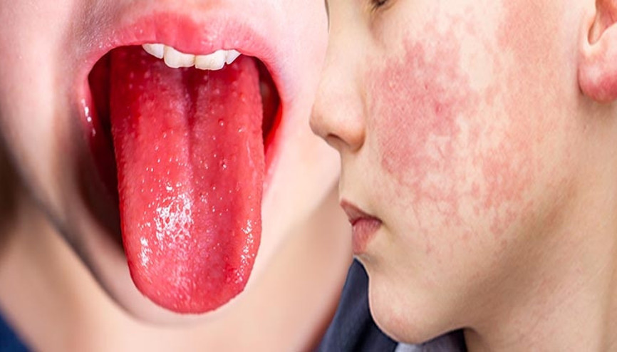 Strep A alarmı bitmeden kızıl endişesi başladı Türkiye’de görülüyor mu Belirtileri neler | 8 SORU 8 YANIT