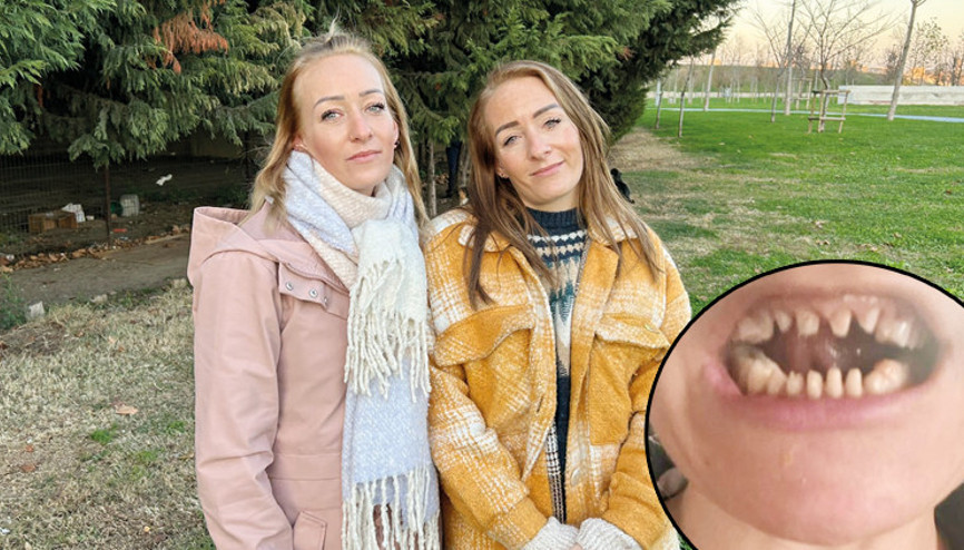 Danimarkalı ikizlerin diş tedavisi kabusa döndü Dişlerinden oldular