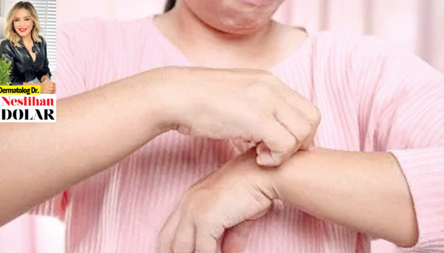Dermatolog Dr. Neslihan Dolar yazdı: Sedef bulaşıcı değil Dermatolog Dr. Neslihan Dolar yazdı: Sedef bulaşıcı değil