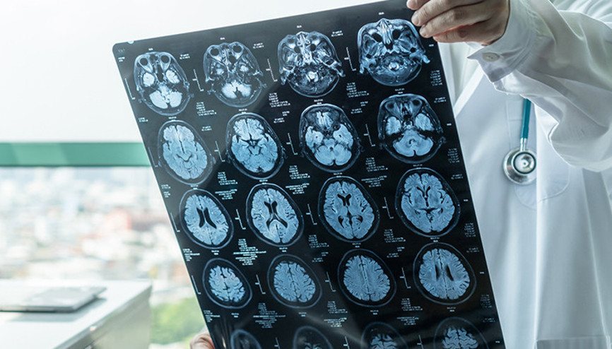 İngilterede beyin sağlığını kontrol için yeni uygulama