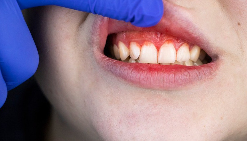 Diş ve dudak kanaması orucu bozar mı Oruçluyken dudak kanarsa ne olur Diş ve dudak kanaması orucu bozar mı Oruçluyken dudak kanarsa ne olur