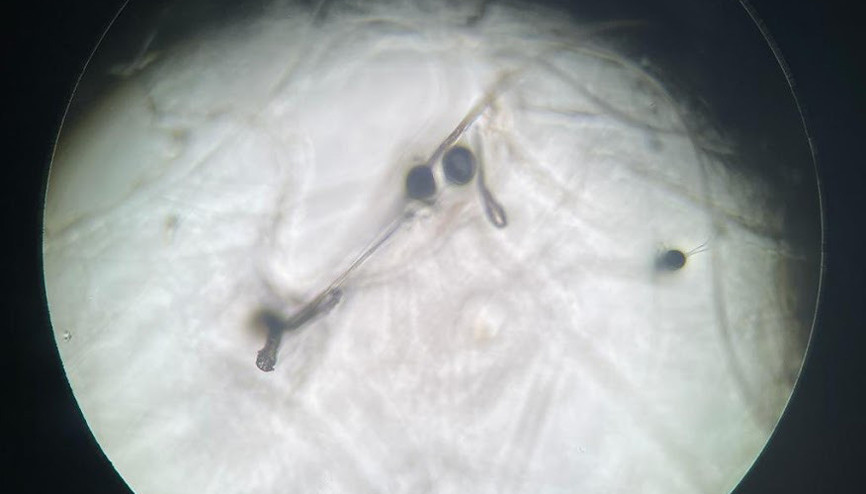 Yüzünüzde kronik kızarıklık varsa dikkat