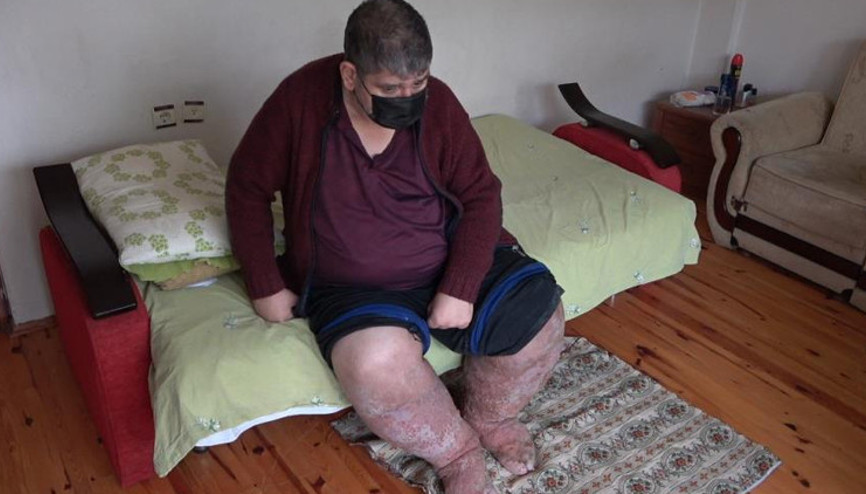 Sivrisinek ısırığı hayatını kararttı Fil hastalığı yüzünden ölümle karşı karşıya Sivrisinek ısırığı hayatını kararttı Fil hastalığı yüzünden ölümle karşı karşıya