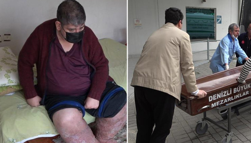 Sivrisinek ısırığı yüzünden hayatını kaybetti Sivrisinek ısırığı yüzünden hayatını kaybetti