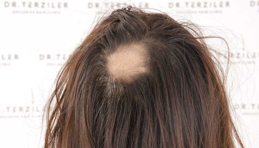 Dr. Servet Terziler: Stresin saçkırana neden olabildiğini biliyor muydunuz Dr. Servet Terziler: Stresin saçkırana neden olabildiğini biliyor muydunuz