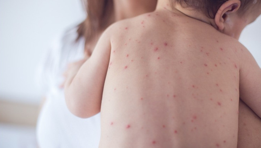 1 yaşında yapılması gereken kızamık aşısını 9uncu ayda yaptırırsak ne olur