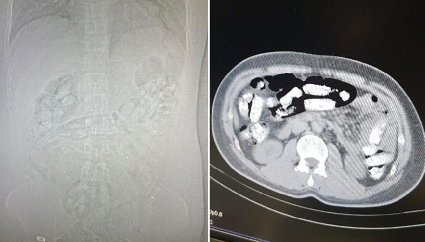 Midesinden 1 kilo 198 gram uyuşturucu çıktı