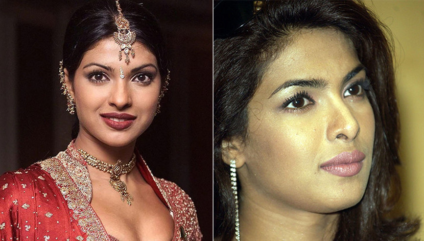 Yanlış burun ameliyatı kariyerinin sonu olacaktı… Adı Plastik Chopra kaldı: Girdiğim depresyondan yıllarca çıkamadım Yanlış burun ameliyatı kariyerinin sonu olacaktı… Adı Plastik Chopra kaldı: Girdiğim depresyondan yıllarca çıkamadım