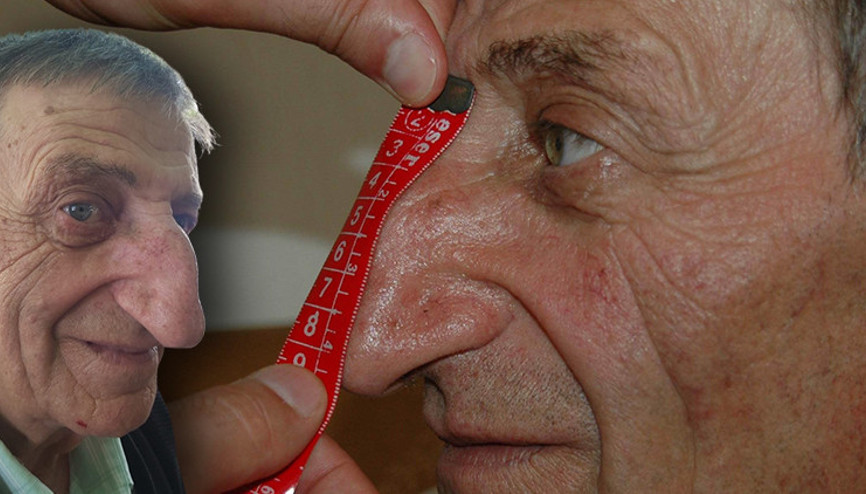 Dünyanın en uzun burunlu insanı Artvinli Mehmet Özyürek kalbine yenik düştü