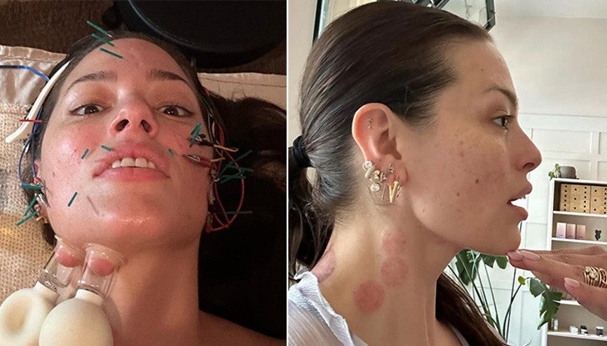 Ne botoks ne de dolgu… Ünlü model milyonlarca takipçisine güzellik sırrını verdi