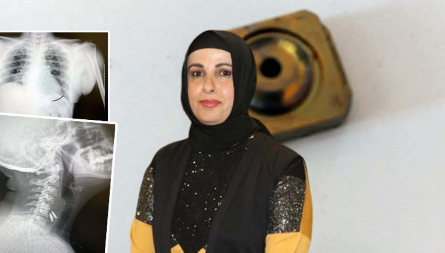 Boynuna takılan implant yemek borusunu yırtıp midesine düştü