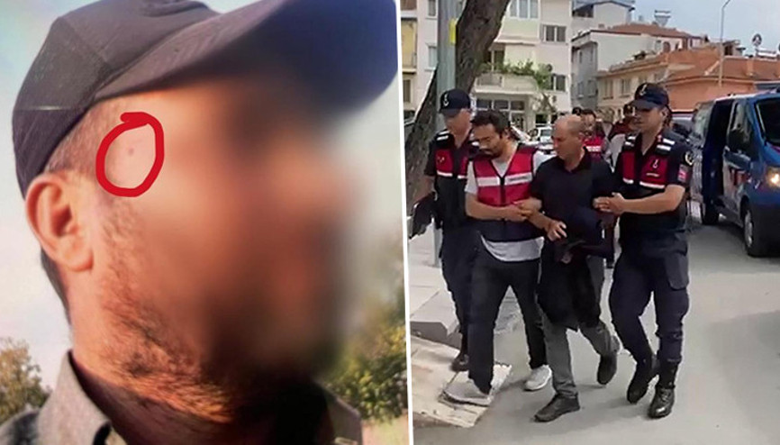 Uyuşturucu şüphelisi, yakalanmamak için şakağındaki beni aldırmış Uyuşturucu şüphelisi, yakalanmamak için şakağındaki beni aldırmış