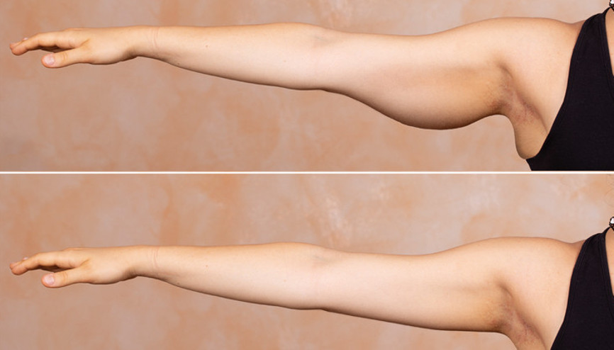 Op. Dr. Bülent Cihantimur yazdı: Zayıflama sonrası sarkan deriler ve ne yapmalı