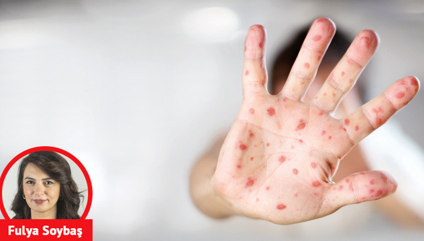 Kızamık vakaları artıyor Peki neden aşı yaptırmıyorlar