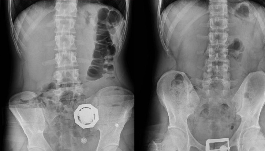 4 şüphelinin midesinden 121 parça halinde 840 gram eroin çıktı