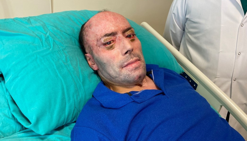 140 ameliyat geçiren 8 ayı aşkın süre hastanede kalan maden işçisi İzzet Ak taburcu edildi