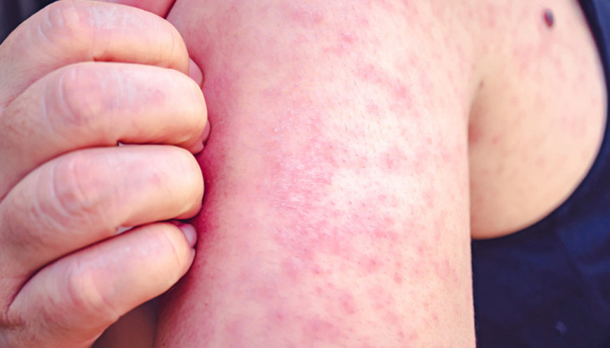 10 SORUDA KIZAMIK DOSYASI I Çocuklardan sonra yetişkinler de risk altında Peki nasıl korunacağız