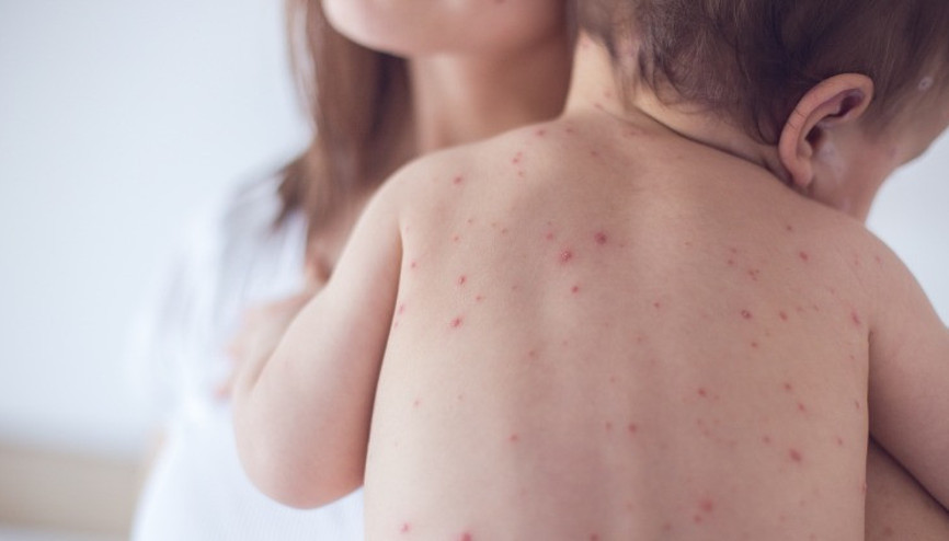Kızamık nedir, belirtileri nelerdir Kızamık döküntüsü nasıl olur, nasıl bulaşır İşte kızamık aşısı ve hastalığı hakkında bilgiler