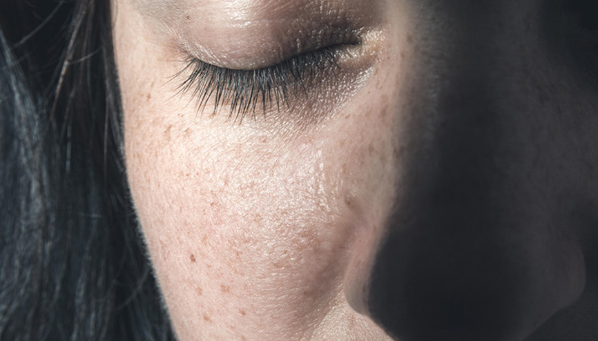 Doktorlar çilimi egzama zannetti, 4üncü evre kanser çıktı... Hangi lekeler tehlikeli Nasıl ayırt edeceğiz