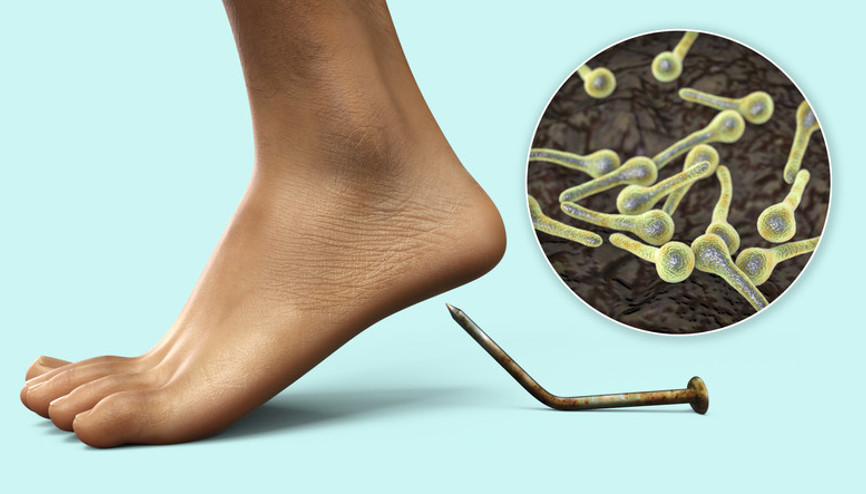 Tetanoz belirtileri nedir, nasıl olur Tetanoz belirtileri nedir, nasıl olur İşte ilk saatlerde ortaya çıkan bulgular