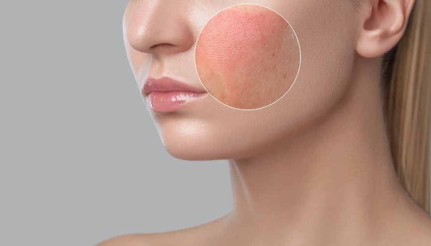 Seboreik dermatit sorunuyla nasıl baş edeceğiz