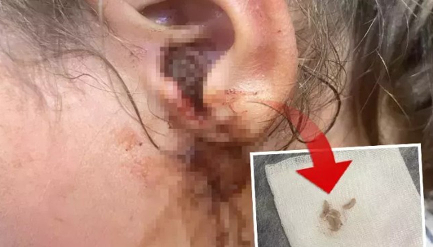 Küçük çocuğun kulağından 23 adet canlı kurtçuk çıkartıldı