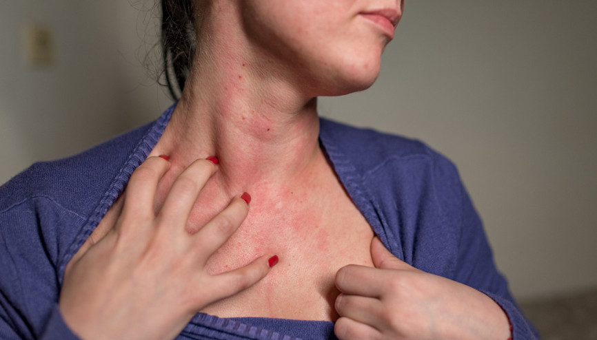 ‘Bugün gelen 8inci vakasın’ Hem dünyada hem Türkiye’de uyuz vakaları ciddi oranda arttı… Bu hastalıktan nasıl korunmalıyız | 6 SORU 6 YANIT