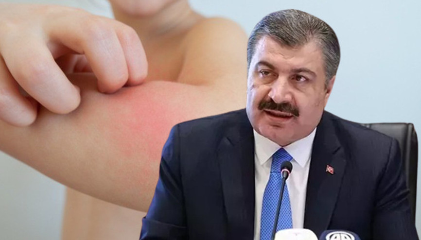 Uyuz hastalığı nedir, nasıl bulaşır Vakalarda artış Sağlık Bakanı Koca açıkladı Uyuz belirtileri neler, tedavisi&nbsp;var&nbsp;mı