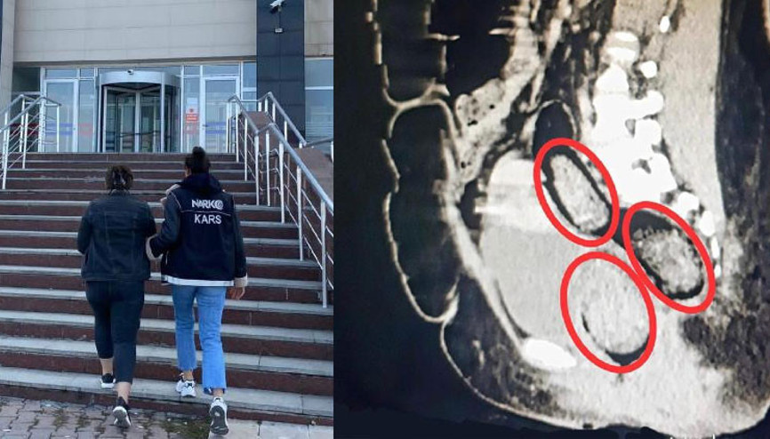 İran uyruklu kadının makatından çıktı Cerrahi operasyon yapıldı