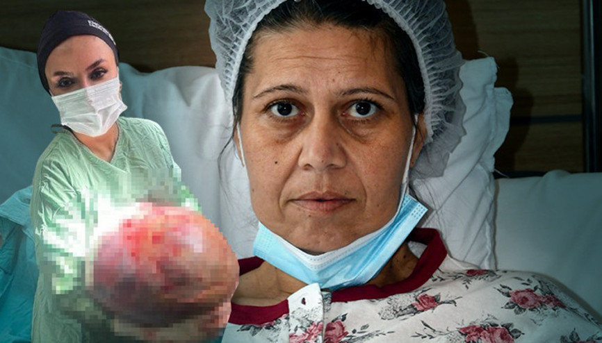 Karın şişliği için hastaneye gitti, gerçeği öğrenince şok oldu 50 santim çapında, 20 kilo ağırlığında: 1 saatlik ameliyatla alındı