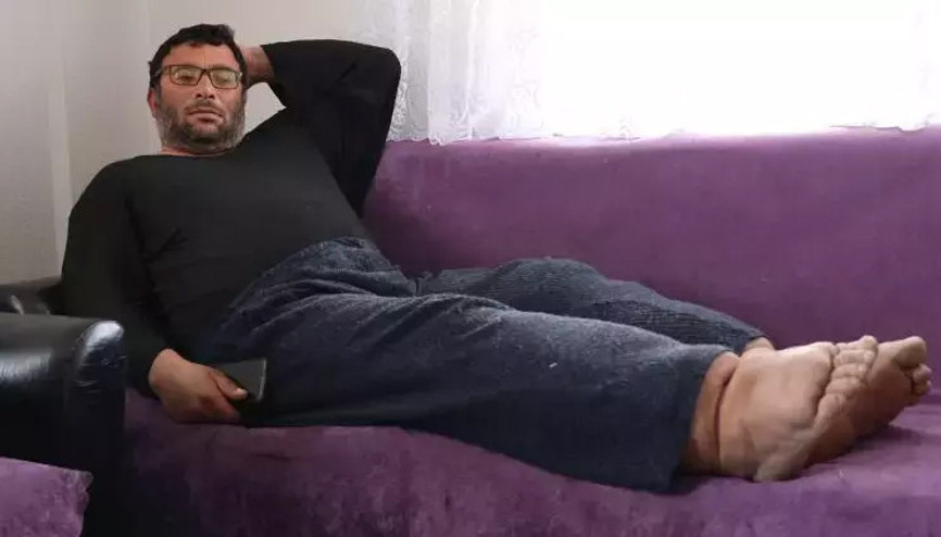 Fil hastalığına yakalandı, bacakları her sene genişliyor