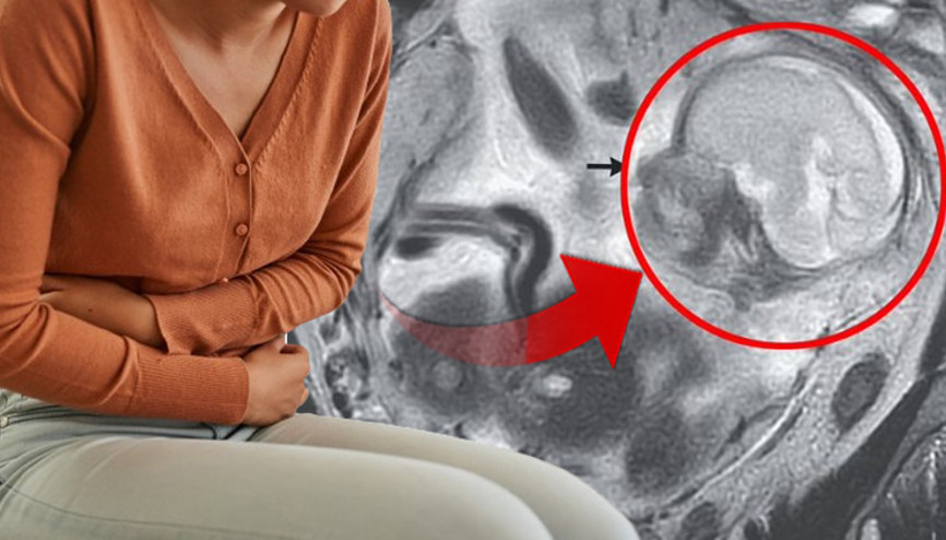 Mide ağrısı ile gitti  5,5 aylık hamile olduğu ortaya çıktı Anne de doktorlar da şoke oldu: Bebek bağırsaklarında büyümüş...