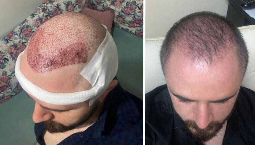 Avukat şikayetçi oldu... Başarısız saç ekimi için mahkemeden emsal karar